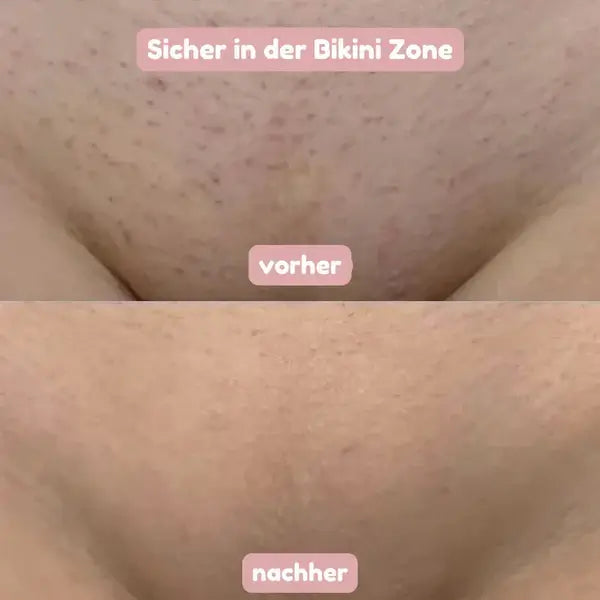 Előtte-utána kép a bikinivonal bőréről: fent szőrcsonkos, pontozott felület, lent a kezelés utáni simább bőr.