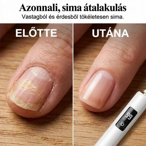 Előtte-utána összehasonlítás: egy egyenetlen, sárgás köröm és ugyanaz a köröm a kezelés után simán 4